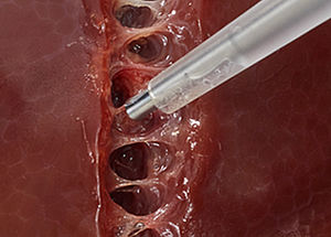 HEPACCS - Tay dao siêu âm và dụng cụ cho phẫu thuật gan