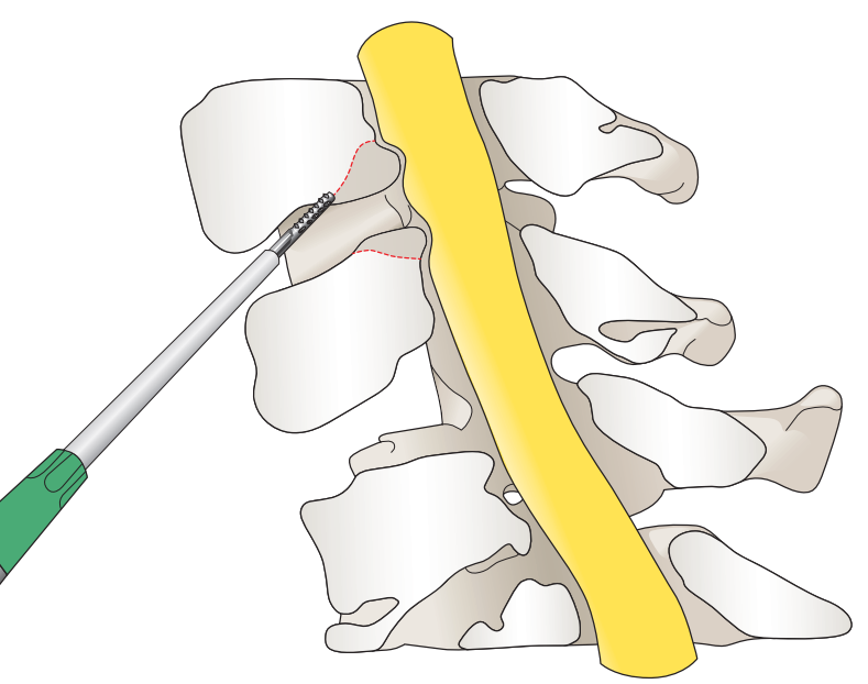 BONE Instrument - Tay dao siêu âm và dụng cụ cắt xương cho phẫu thuật cột sống